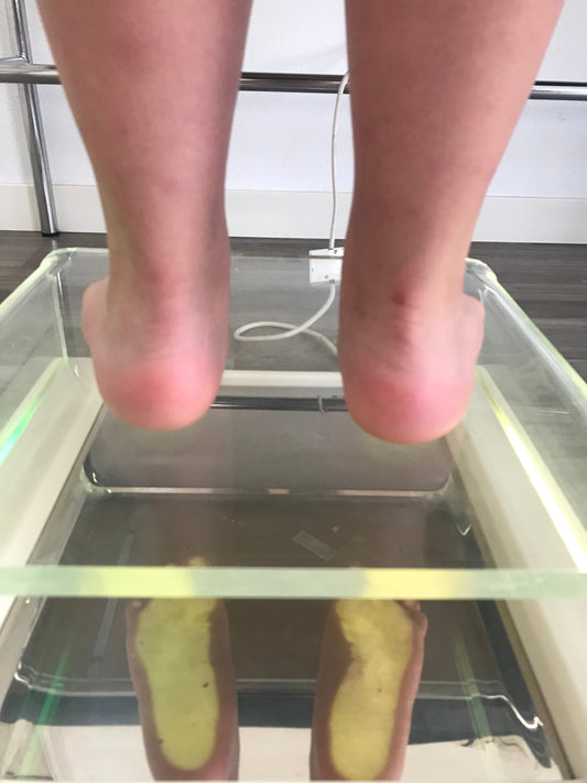 Enfermedad de Sever: Qué es, Síntomas y Tratamiento para el Dolor de Talón en Niños